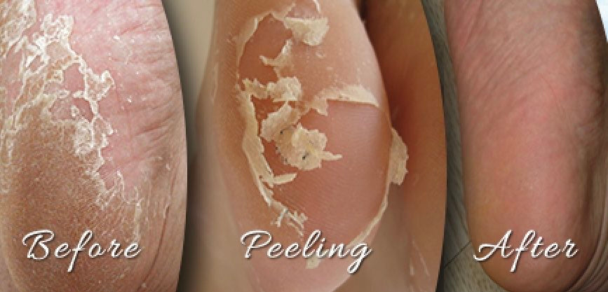 Baby Foot - Exfoliant peau profonde